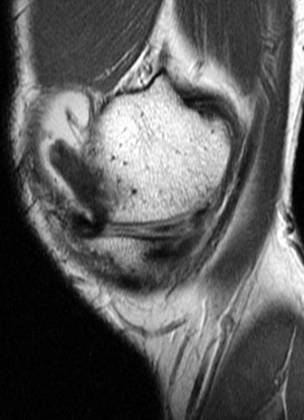 Figure 3 for case Unstable flap tear, medial meniscus